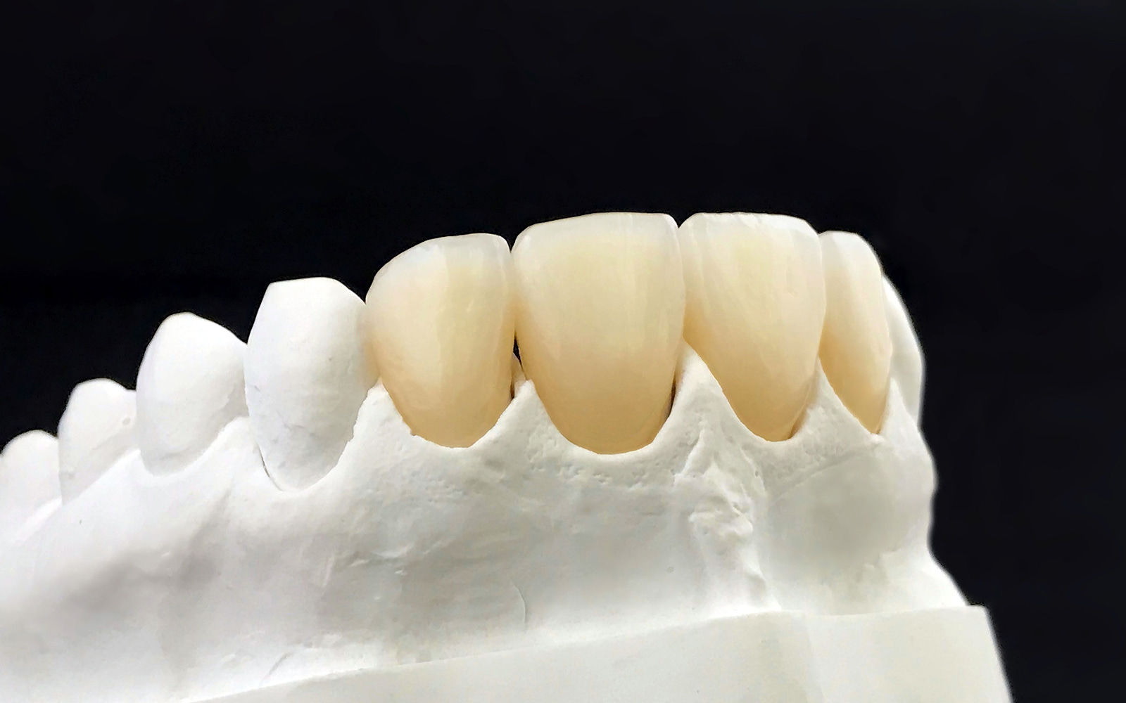 Zirconia Fixed Bridge