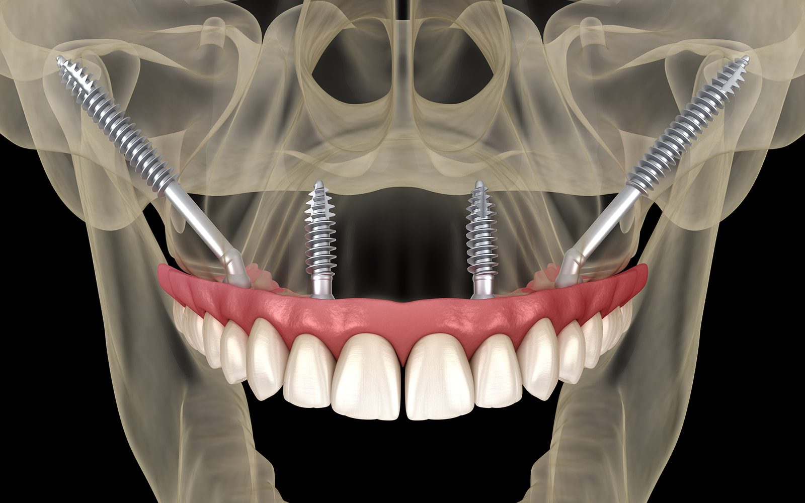 Zygomatic Dental Implants