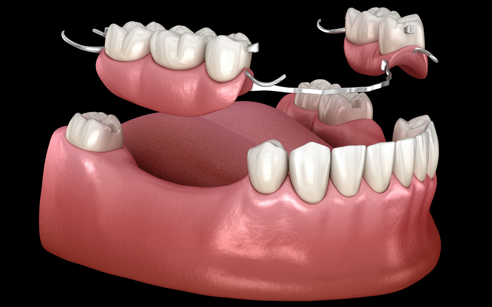 Full and Partial Dentures