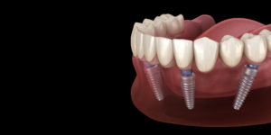 all on 4 dental implants graphics.