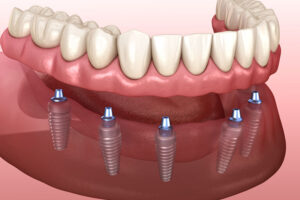denture supported implants with 6 implants supporting it