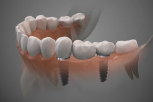 2 single dental implants with 2 crowns on top of each of the implants